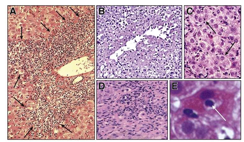 Autoimmune hepatitis Liver biopsy abnormalities are similar to those described for chronic viral hepatitis.
