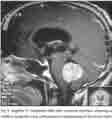 Right cranial nerve VI palsy