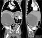 Diagnosis CT scan Histology Urinary levels of catecholamines: homovanillic acid (HVA) and