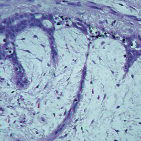 56 8 Benign Changes Fibroadenoma Fibroadenomas (Fig. 8.8) are mixed fibroepithelial tumors.