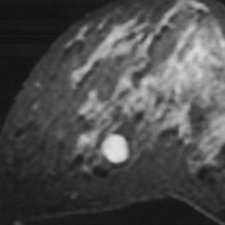 58 8 Benign Changes MR mammography: Fibroadenoma T2-weighted sequence Signal behavior is dependent upon the histological composition of the