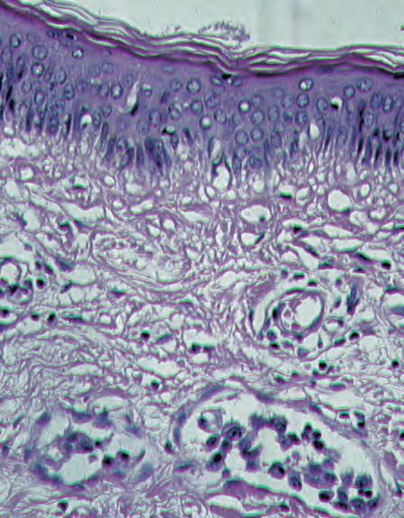 128 9 Malignant Changes Other Tumor Forms Inflammatory Carcinoma Inflammatory carcinoma does not constitute a histological type but rather a clinical entity (Figs. 9.33 9.35).