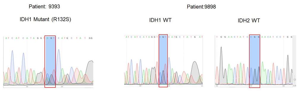 Supplementary Materials: Supplementary Figure 1. IDH1 and IDH2 mutation site sequences on WHO grade III patient samples.