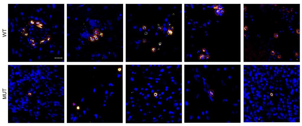 Supplementary Figure 2. CD3 + CD8 + cells in WHO grade III glioma tissue by immunofluorescence.