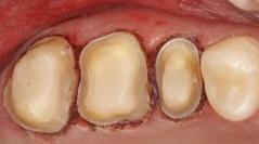 gingivectomy to increase crown margin