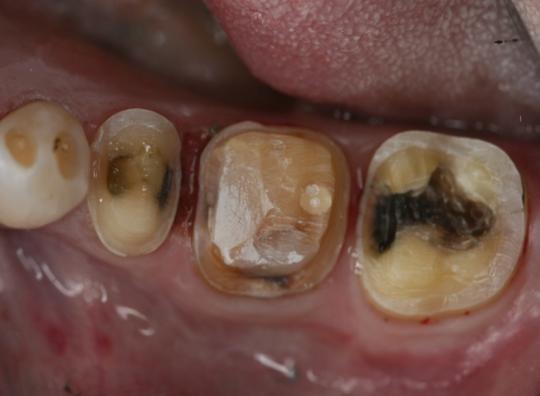 Existing Restorations with recurrent