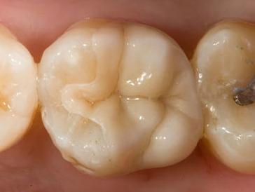 Crowns (Chairside and Dental