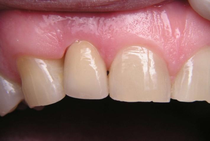 Implant Supported Crown Stained and