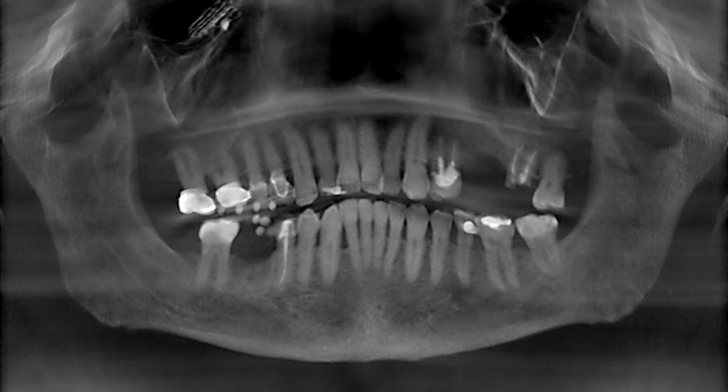 Combining Galileos 3D Conebeam / CT Scan and Cerec Technology Radiopaque fiduciary