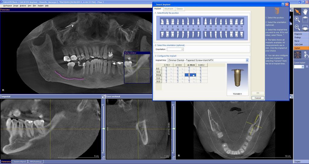 Implant selection using software