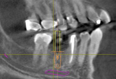 Implant Positioning: Guidelines: