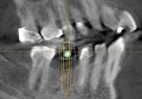 Implant Positioning: Outline of