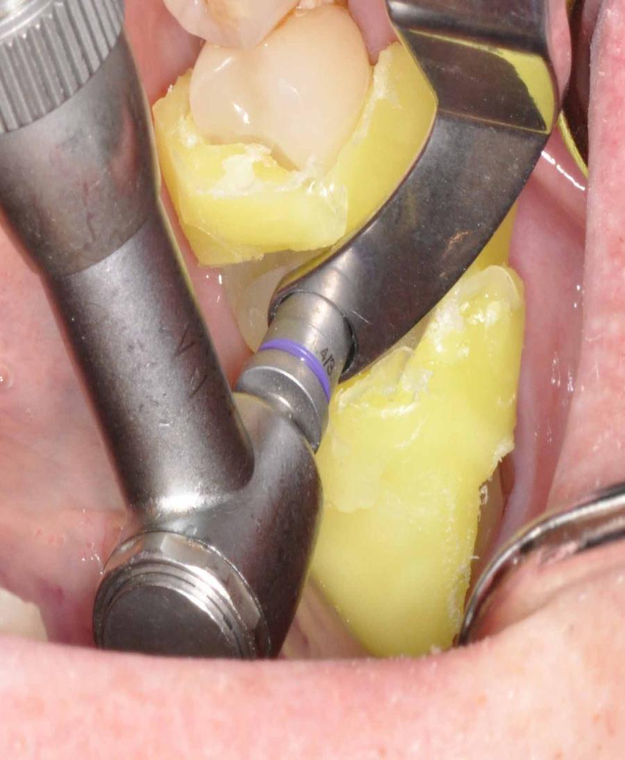 Implant site Tissue punch