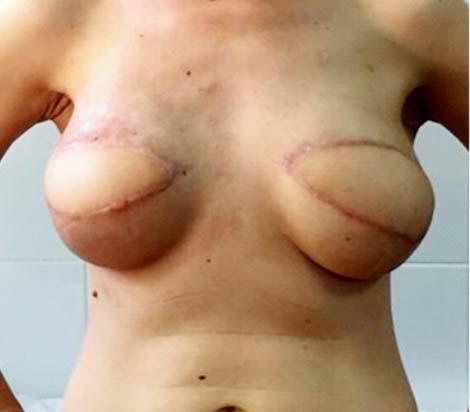 reconstruction with latissimus dorsi flap and implant