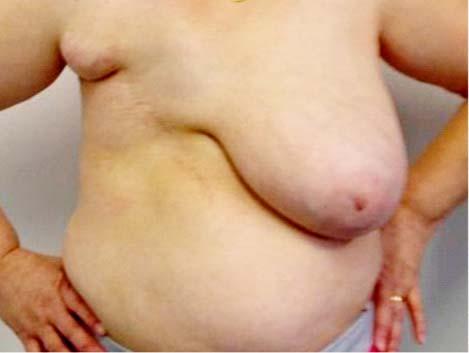 Postoperative aspect of breast  - profile Figure 13.