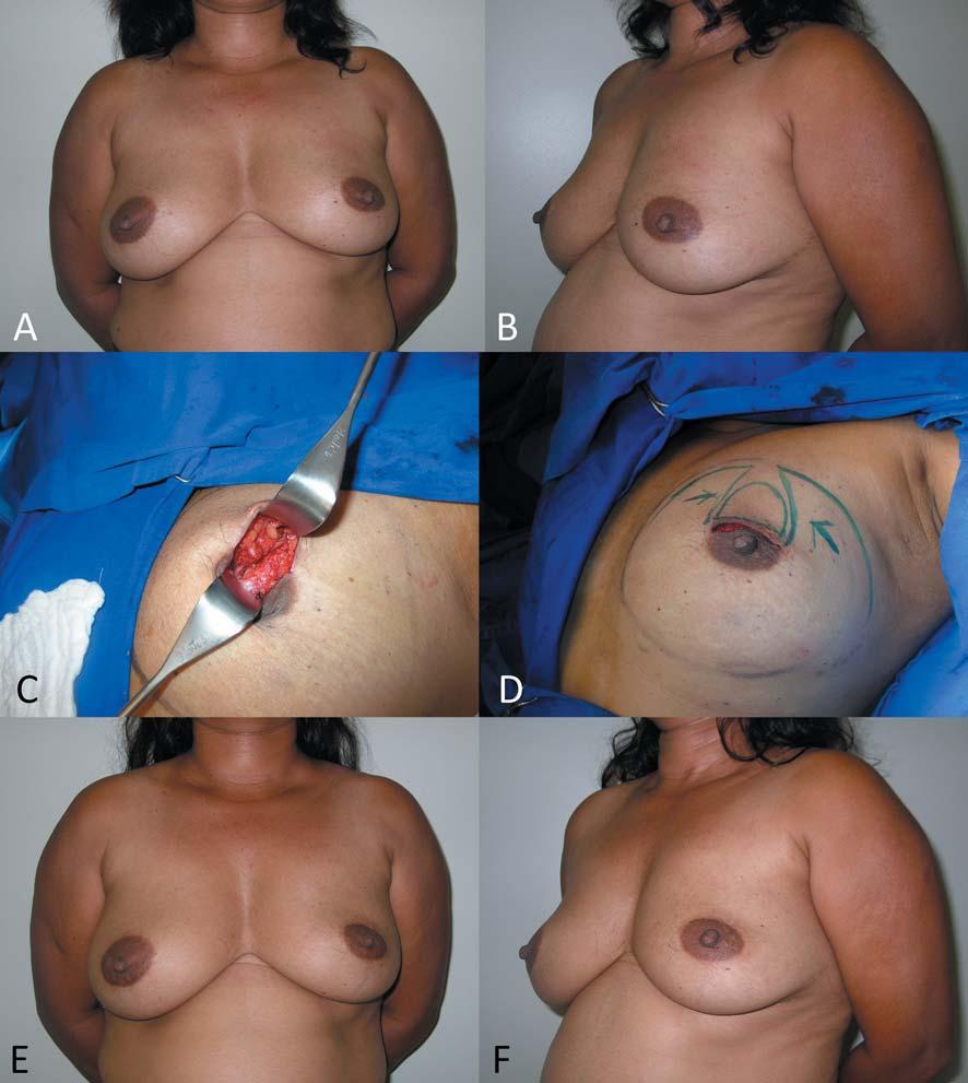 Figures 1. A 51-years-old patient with invasive ductal carcinoma (2.9 cm) of the left breast (A-B, above left and right).