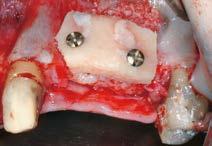 insufficient width for implant placement Autologous bone blocks are subject to resorption Aim / Approach: