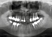 8 Long-term follow-up showing stable peri-implant bone level 3 years after implant placement.