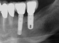 Conclusion: The crest splitting technique allows the placement of implants in anatomic situations with