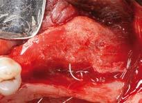 4 Primary wound closure is obtained with a combination of mattress and single interrupted sutures.