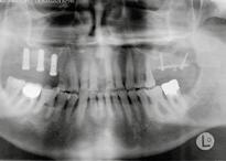 horizontal anterior maxilla particulate screws vertical posterior mandible block 1 2 3 4 5 6 7 8 1 Preoperative radiograph
