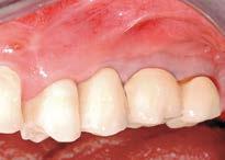8 Clinical picture 7 years post surgery showing stable and excellent esthetic outcome.
