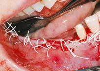 4 The eptfe barrier membrane is secured on the lingual and buccal side by two fixation screws on each side.