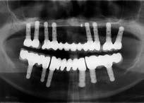 7 Panoramic X-ray after implant placement. 8 8 year follow-up showing stable peri-implant bone levels and preserved vertically augmented bone.