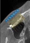 Approach: Correction of skeletal discrepancy performing Le Fort l osteotomy Osteoplasty within