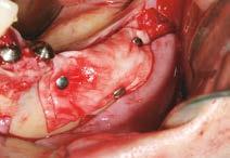 Geistlich Bio-Oss Geistlich Bio-Gide Defect Region Autologous bone Additional means horizontal anterior maxilla particulate screw