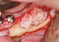 alveolar ridge. Moreover, this avoids potential complications during the healing process and the collapse of the membrane.