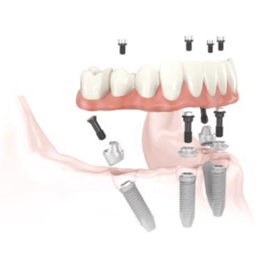 Watson Dental Lab Fixed Hybrid Protocol Watson Dental Lab has put Protocols in place to: Ensure maximum quality and fit of the final restoration. Maximize Dr.