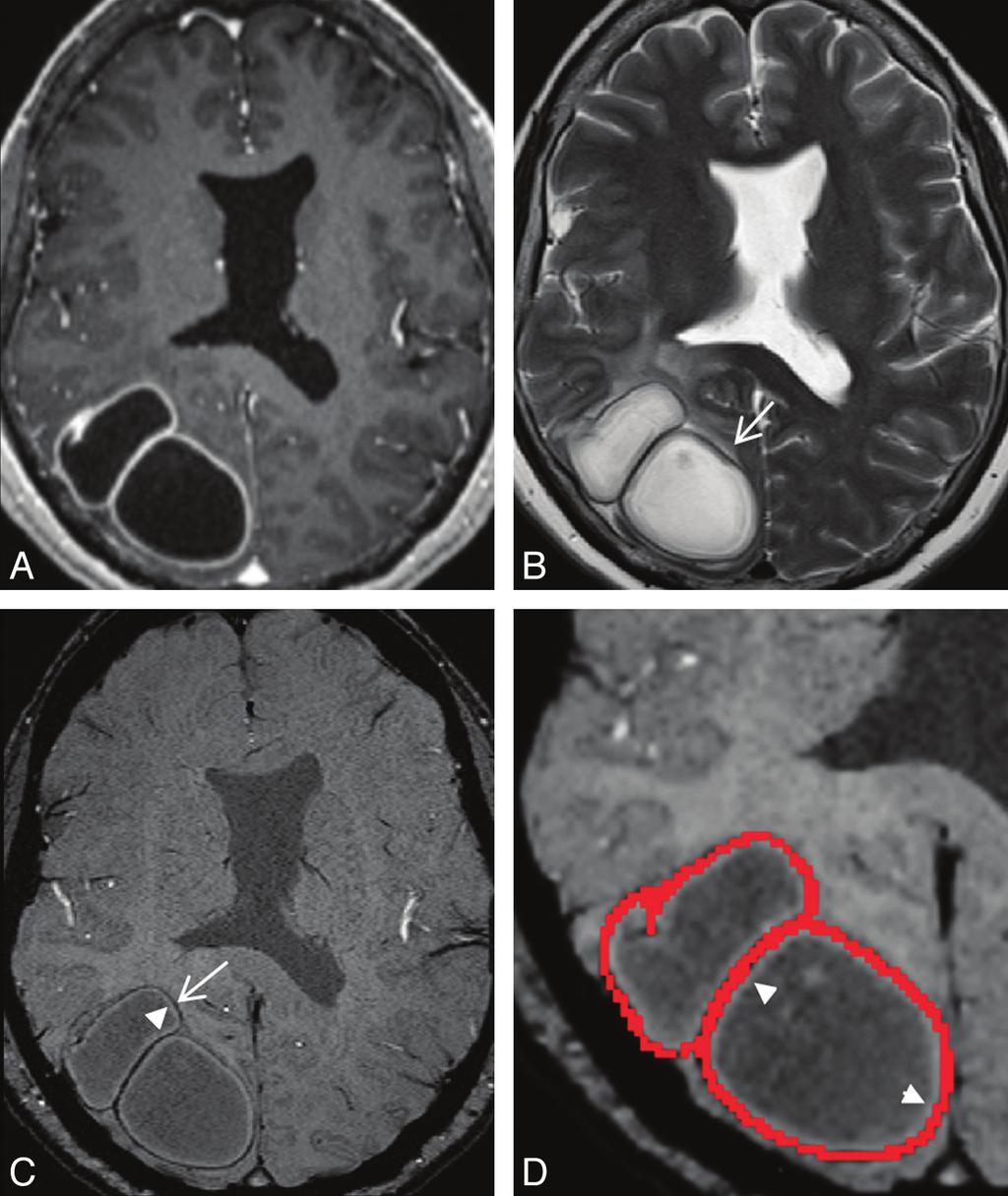 Fig 1. A 56-year-old woman with 2 right occipital pyogenic brain abscesses. A, Transverse contrast-enhanced MPRAGE shows 2 adjoining rim-enhancing masses in the right occipital lobe.