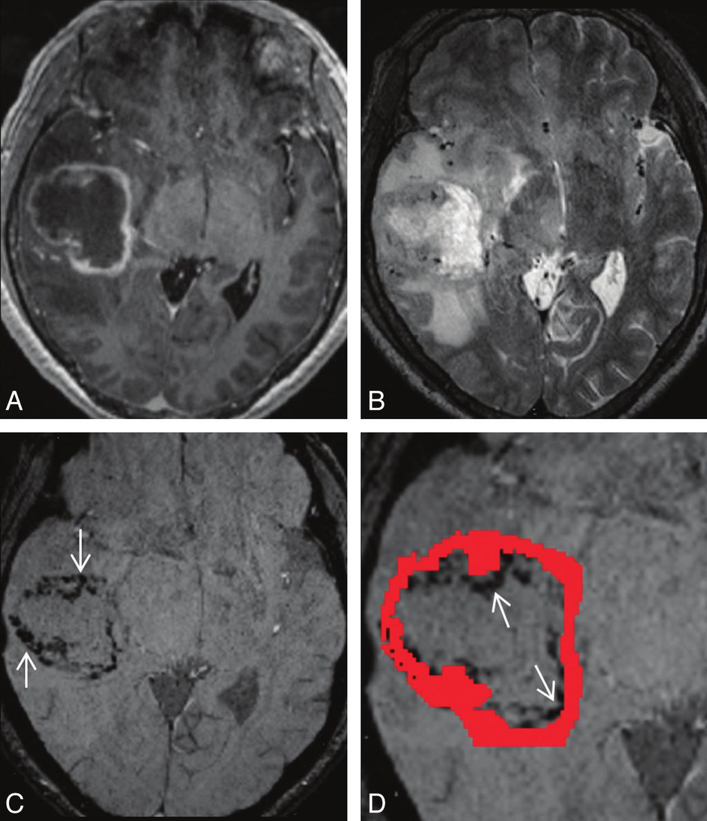 Fig 2. A 57-year-old man with a right temporal necrotic glioblastoma. A, Transverse contrast-enhanced MPRAGE shows a rim-enhancing mass in the right temporal lobe.
