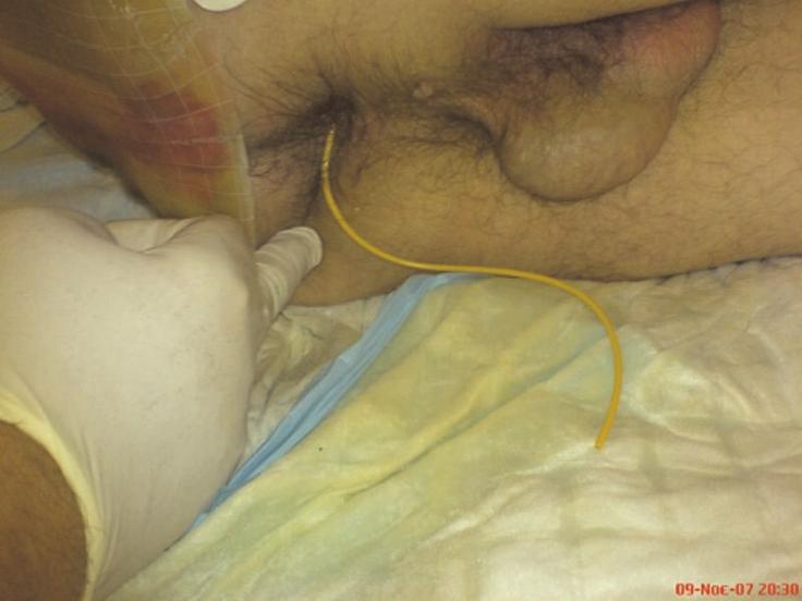 recognition and prompt management of the colonic perforation and its ominous complications [2].