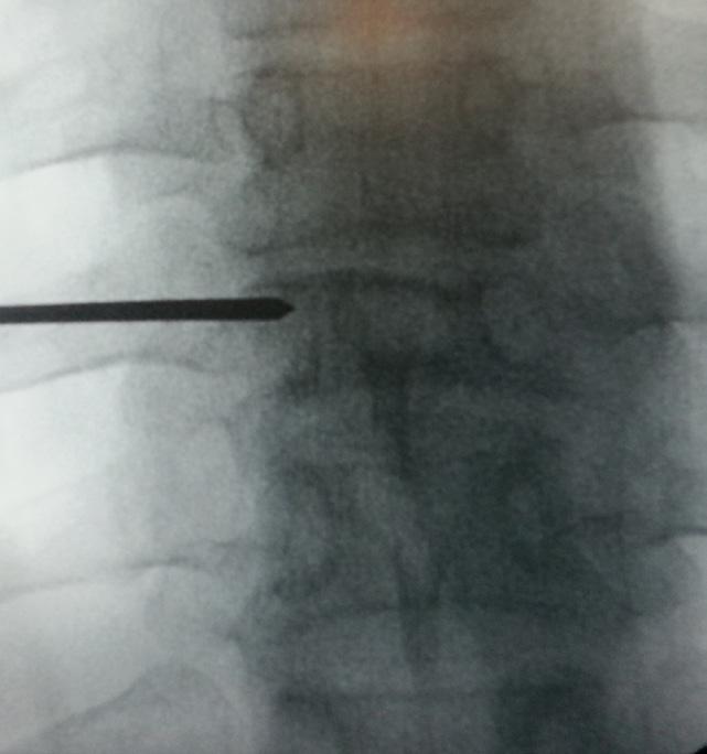 Figure 2. Kirschner wire tpped up to posterior order of verterl ody (2) nd position confirmed on AP view (2). Figure 3.