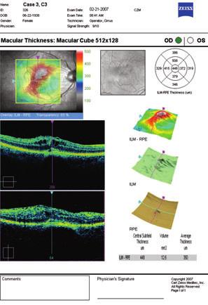 At a Glance: Critical Details Macular Thickness Report Patient Name Slide Navigator enables a simultaneous view of a selected point on LSO image, OCT fundus image, HD thickness map, HD layer maps,