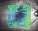 disturbances to the fundus, using RPE-RPE fit map HD OCT image reveals the retinal layers in exquisite detail.