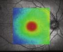 caused by traction from the ERM HD thickness map indicates thickening of retinal tissue Tissue layer overlay demonstrates the extent