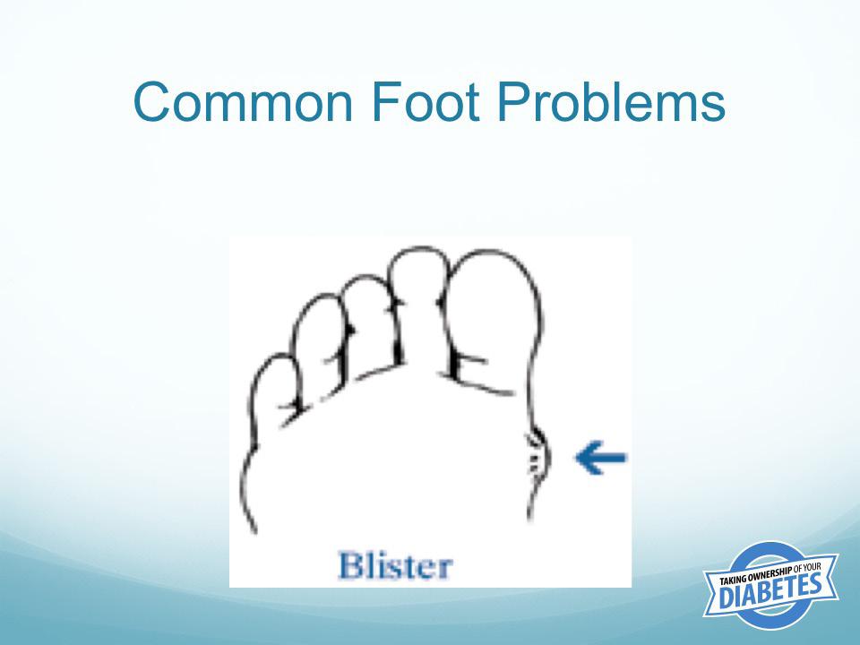 Blisters occur because of friction or constant rubbing on the same spot. A common way to get a blister is by wearing ill-fitting shoes.