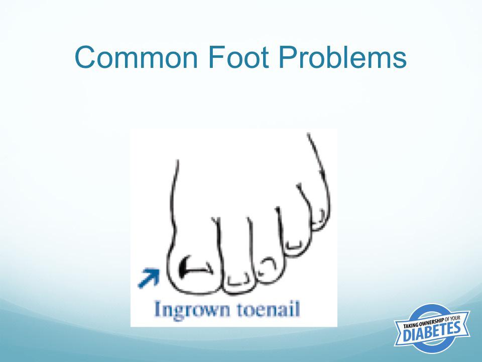 Ingrown toenails happen when an edge of the nail curves down and grows into the toe. This is most frequently seen on the big toe. Ingrown toenails can be painful and can cause infections.