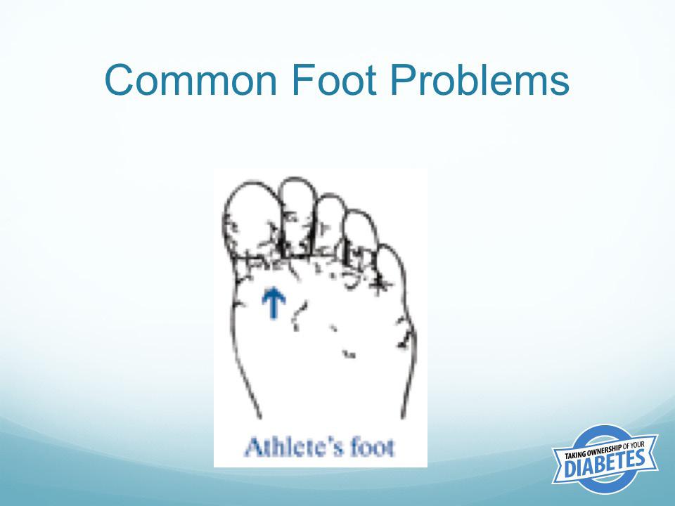 Hammertoes form when the foot muscle gets weak. This can happen with diabetic nerve damage. The weakened muscle makes the tendon in the foot shorter and makes the toes curl under the feet.