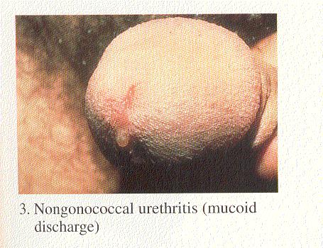 ejaculation Abdominal pain Testicular