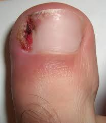 Toenails that break through or cut into the skin or tissue around them, causing pain
