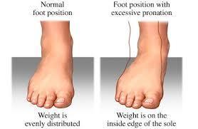 The result of a combination of factors in the tarsal and metatarsal area of the foot which lowers the arch and allows the