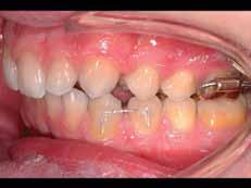 Incognito bands are fabricated over the occlusal surface of the tooth and do not fit interproximally. This means that you will not need spacers.
