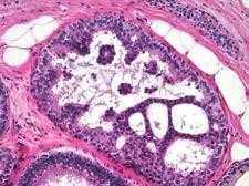 Pathology Subspecialties Breast Pathology The Breast Pathology service provides diagnostic expertise in the interpretation of breast lesions from various specimen types, including needle core