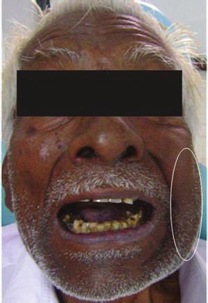 2 Case Reports in Pulmonology Figure 1: Swelling on left side of the face with associated trismus.