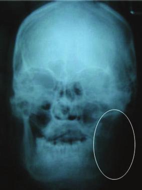 Figure 2: Posteroanterior view of skull revealing osteolysis involving left body and ramus of the mandible till the condylar head.