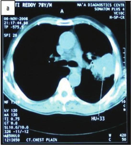 Case Reports in Pulmonology 3 (a) (b) Figure 4: (a) CT chest revealed lesion in the left lung.